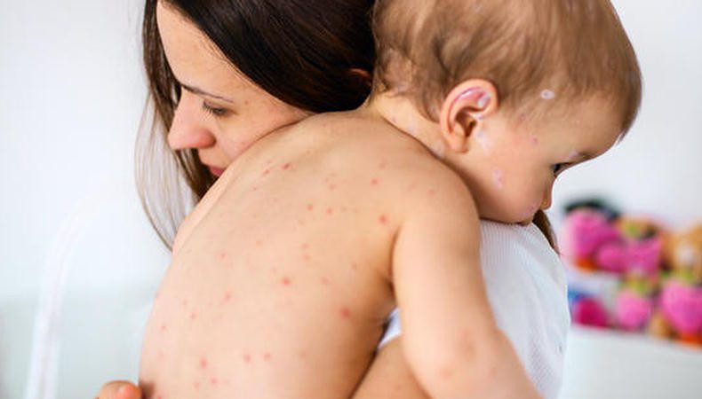 آبله مرغان در کودکان