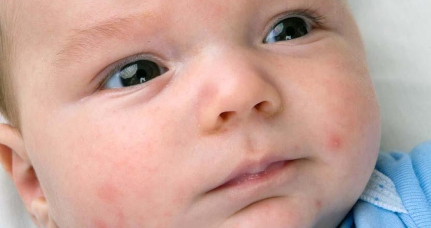 آکنه نوزادی، دلایل و درمان