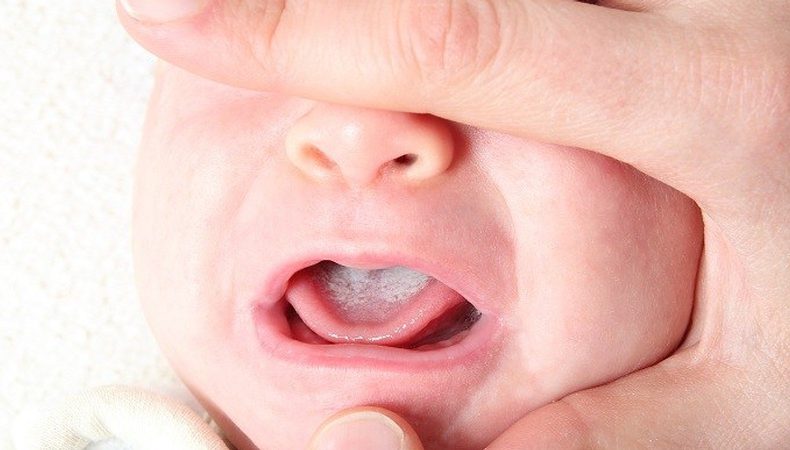 برفک دهان نوزاد
