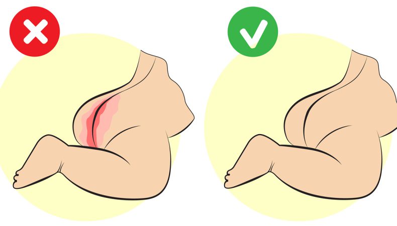 بثورات پوشکی نوزاد