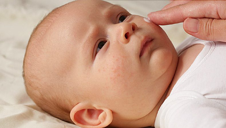اگزما در نوزادان
