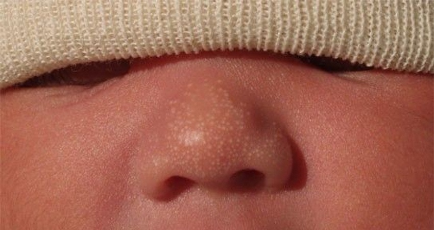 علت و درمان میلیا در نوزادان