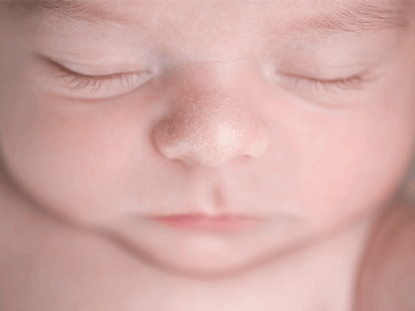 علت و درمان میلیا در نوزادان