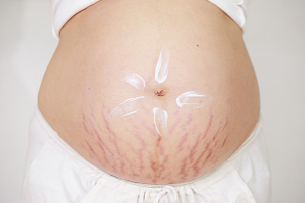 ترک های پوستی در دوران بارداری