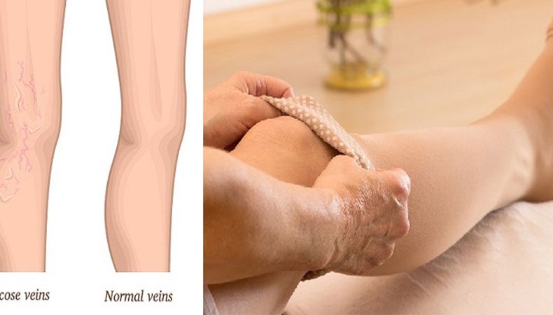 علت و درمان واریس در بارداری