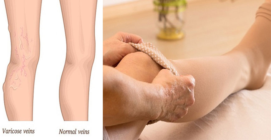 علت و درمان واریس در بارداری