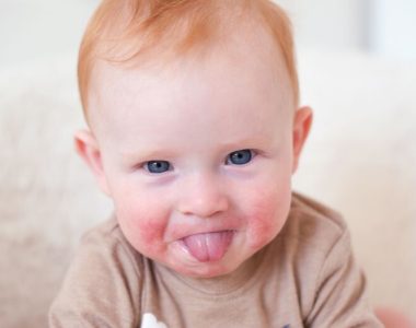 سندرم آلرژی دهانی نوزاد و کودک