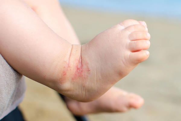 آلرژی و حساسیت به مواد غذایی در بچه ها