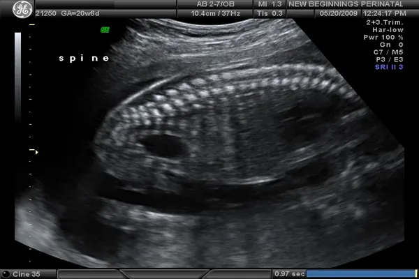 سونوگرافی بیوفیزیکال چیست